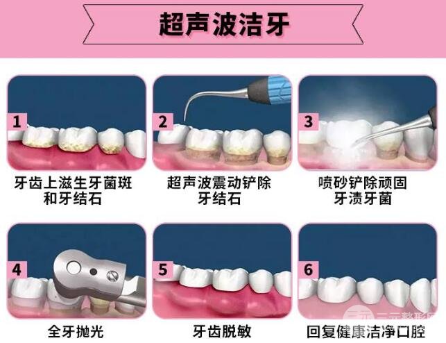 洁牙