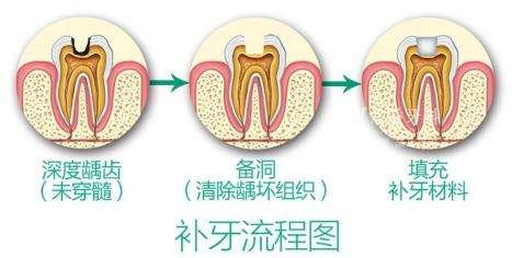 补牙