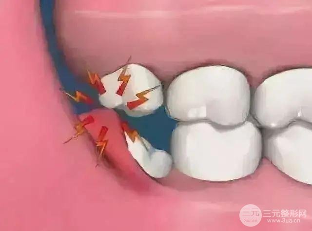 阻生齿