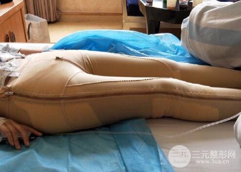 光纤溶脂瘦大腿术后