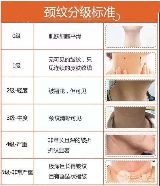 颈纹严重程度