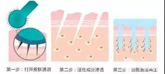 微针美容过程