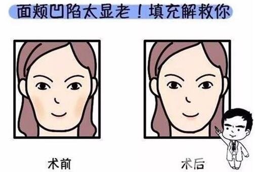 面部填充术