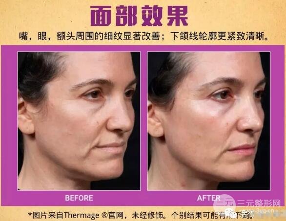 热玛吉抗衰去皱果图