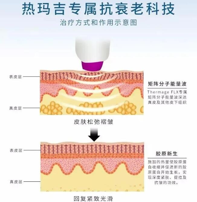 热玛吉面部塑形