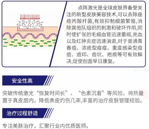 点阵激光