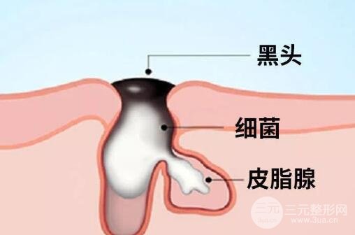 黑头是什么