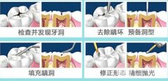 怎么矫正门牙牙缝大?只能用正畸一种方法么? 怎么矫正门牙牙缝大?只能用正畸一种方法么?