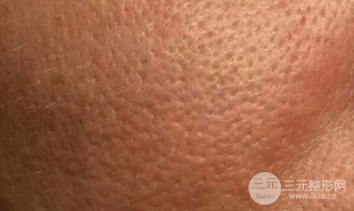 毛孔粗大