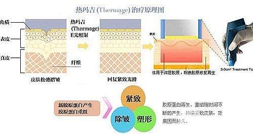 热玛吉原理