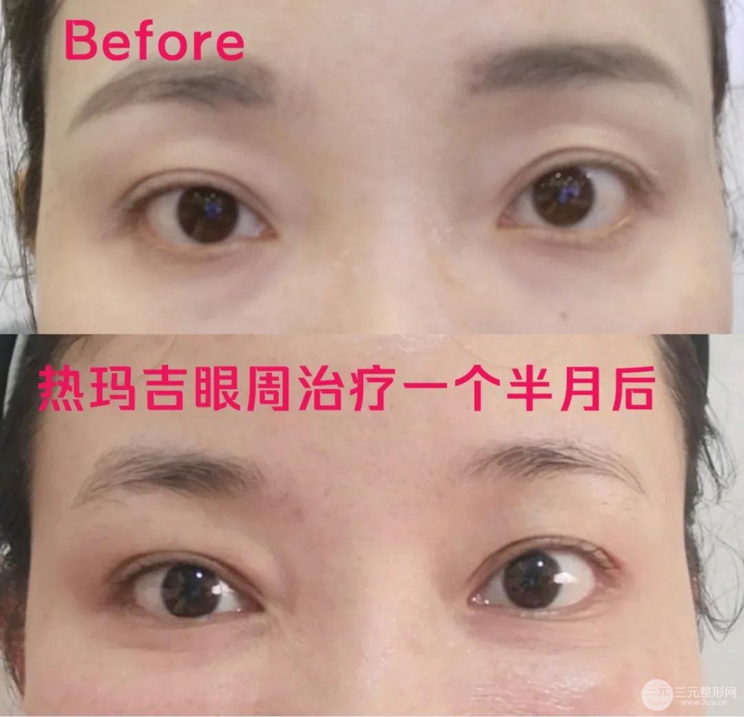 热玛吉紧肤果测评反馈