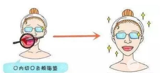 在去除颊脂垫手术后，会不会有脸颊凹陷?