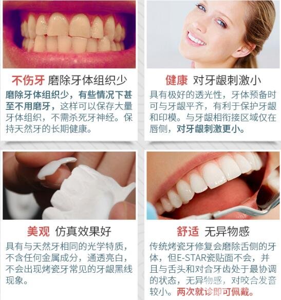 牙齿贴面
