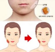 去颊脂垫是什么？有什么危害吗？瘦脸果图一览！