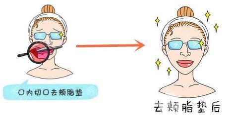 去颊脂垫适合哪些人