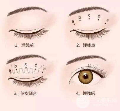 高分子埋线双眼皮原理