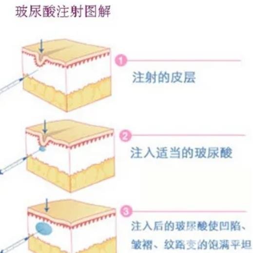 玻尿酸填充额头