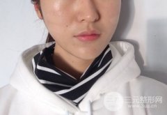 鼻唇沟微整形多少钱?这些方法让你更耐老~ 鼻唇沟微整形多少钱?这些方法让你更耐老~