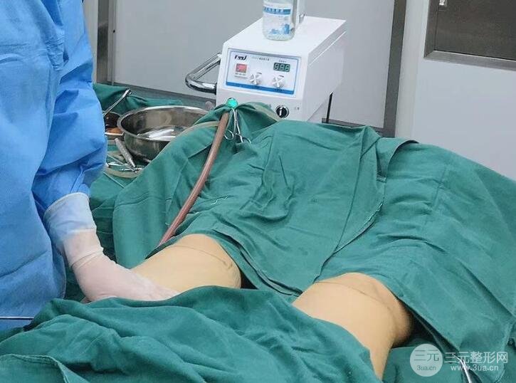 共振吸脂减肥术中