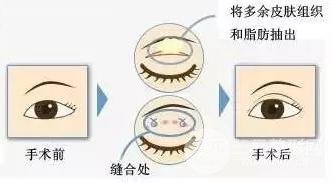 眼部吸脂手术过程