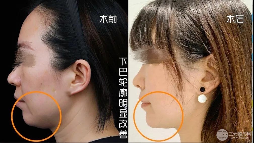 玻尿酸丰下巴