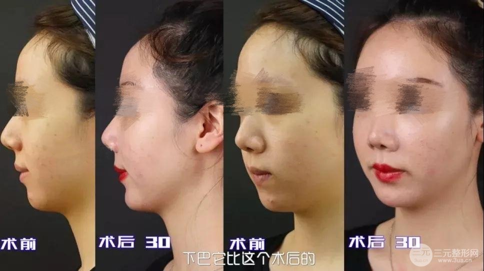 脂肪填充丰下巴
