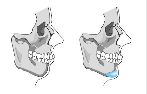 硅胶垫下巴多少天能恢复呢?