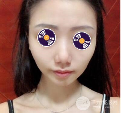 手术后多久可以上班?