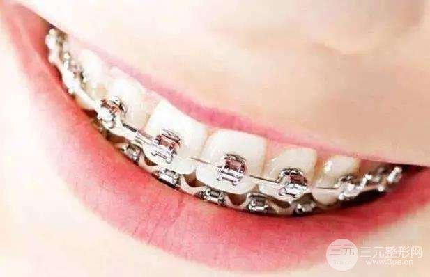 牙套什么年纪带