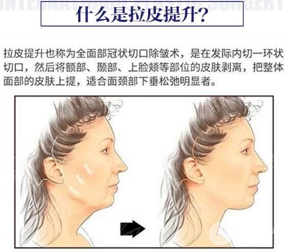 拉皮手术