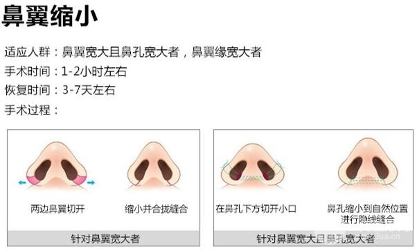 鼻翼缩小手术科普