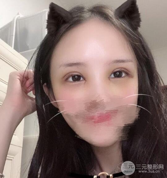 南京刘育凤双眼皮案例欣赏7mm双眼皮开眼角术后果美晕了