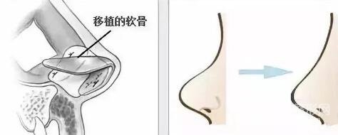 假体隆鼻的果自然吗?好吗?