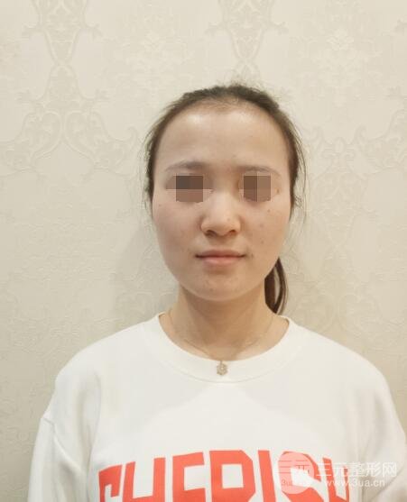 假体隆鼻果术前