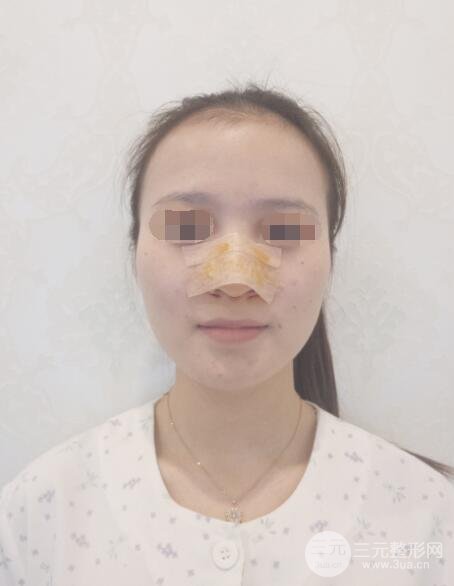 假体隆鼻果术后2天