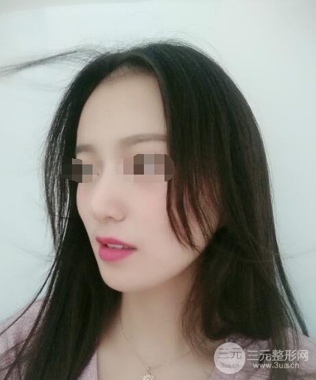 假体隆鼻果术后50天