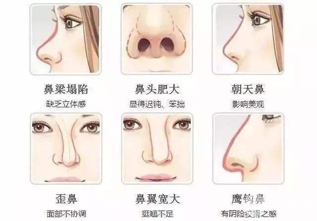 鼻尖畸形整形要多少钱？附3张案例图~