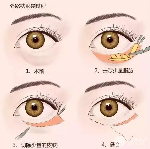 有眼袋是什么原因造成的