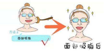 面部吸脂瘦脸手术科普