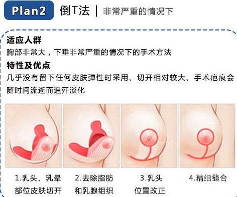 手术方法 适宜人群