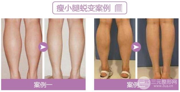 小腿吸脂果图对比
