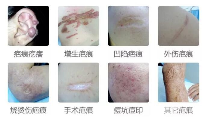 疤痕切除手术多少钱?