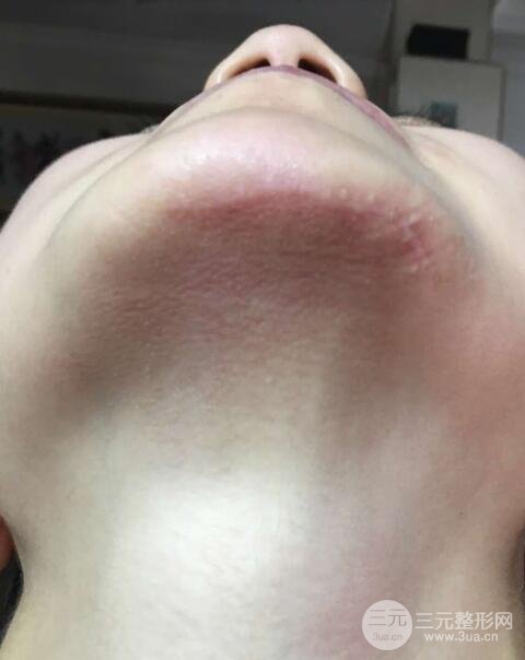 疤痕切除手术果怎么样?