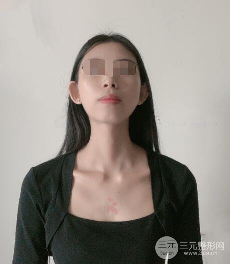 疤痕切除手术案例术后2周