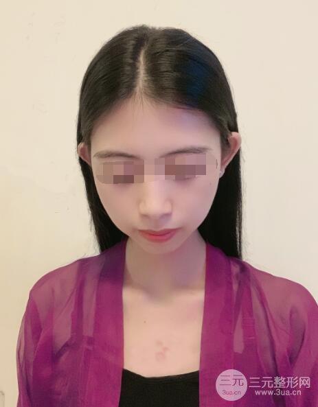 疤痕切除手术案例术后4周