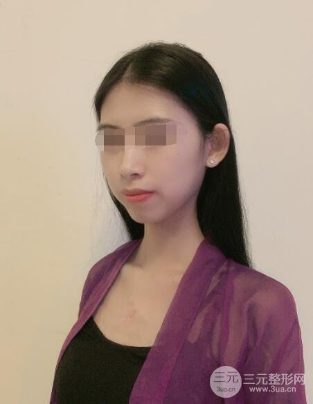 疤痕切除手术案例术后9周