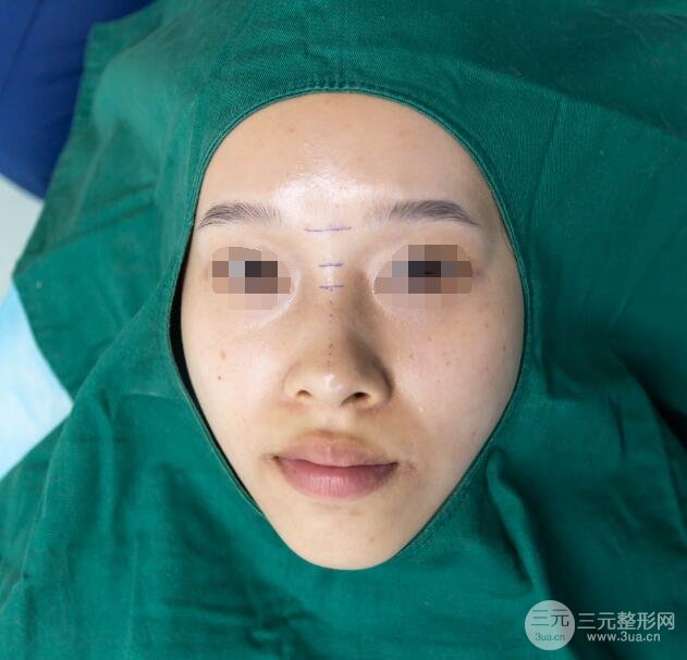 硅胶隆鼻案例反馈术前