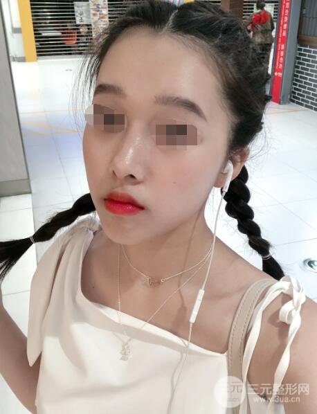 硅胶隆鼻案例反馈术后1个月