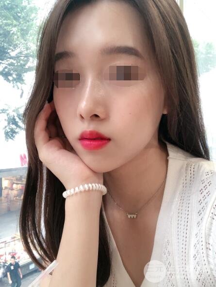 硅胶隆鼻案例反馈术后4个月