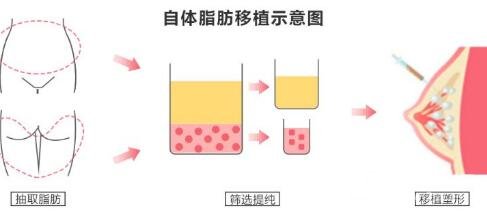 自体脂肪隆胸价格越贵越好?